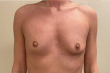 Breasts before breast augmentation, front view, patient 11 — Dr. Rudderman, Atlanta.