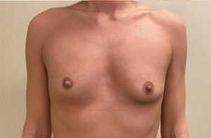Breasts before breast augmentation, front view, patient 11 — Dr. Rudderman, Atlanta.