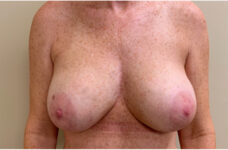 Breasts before breast implant removal with lift, front view, patient 2 — Dr. Rudderman, Atlanta.