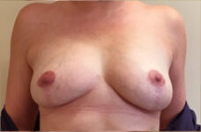 Breasts after breast implant removal with lift, front view, patient 3 — Dr. Rudderman, Atlanta.