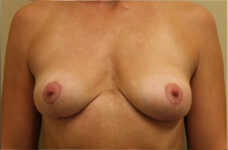 Breasts after breast implant removal with lift, front view, patient 4 — Dr. Rudderman, Atlanta.