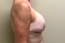 Breasts before breast implant removal with lift, side profile view, patient 9 — Dr. Rudderman, Atlanta.