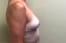 Breasts after breast implant removal with lift, side profile view, patient 9 — Dr. Rudderman, Atlanta.