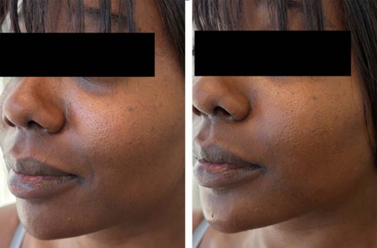 Before and after dermal filler treatment, three-quarter view of the lower face, patient 2 — Dr. Rudderman, Atlanta.