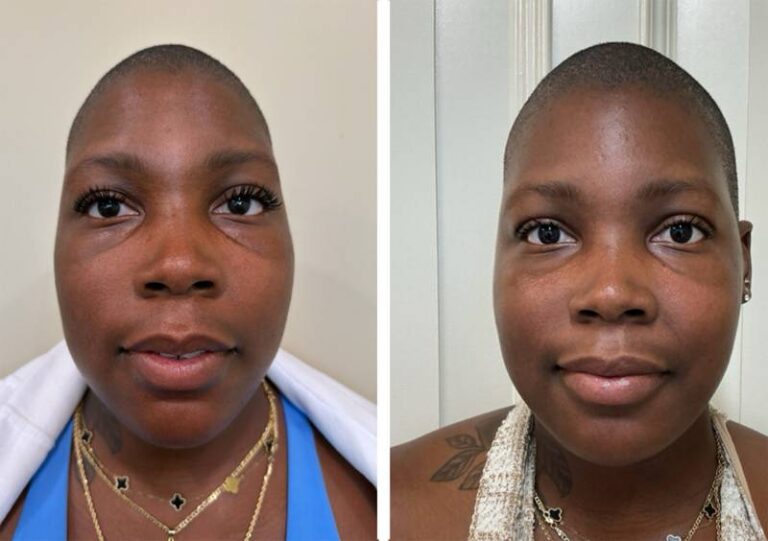 Before and after facial balancing filler, front view of the face, patient 1 — Dr. Rudderman, Atlanta.