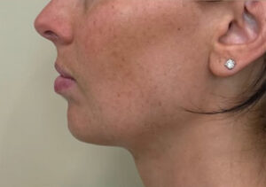Jawline and chin before facial balancing filler, side profile view, patient 9 — Dr. Rudderman, Atlanta.