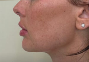 Jawline and chin after facial balancing filler, side profile view, patient 9 — Dr. Rudderman, Atlanta.