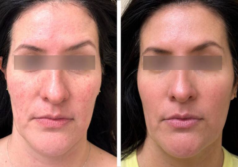 Before and after Quanta laser skin treatment, front view of the face, patient 1 — Dr. Rudderman, Atlanta.