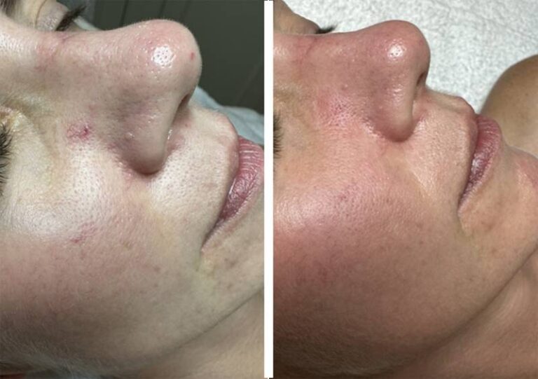Before and after Quanta laser skin treatment, three-quarter view of the cheek and nose, patient 2 — Dr. Rudderman, Atlanta.