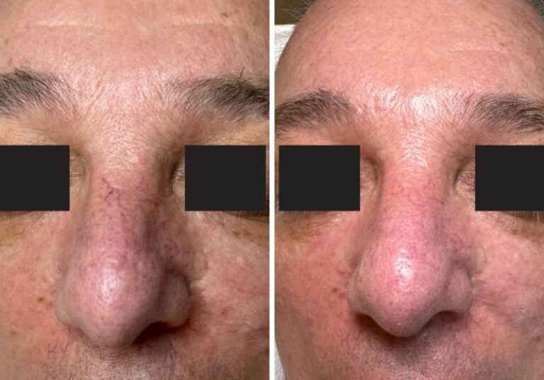 Before and after Quanta laser skin treatment, front view of the nose and midface, patient 3 — Dr. Rudderman, Atlanta.